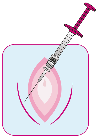 Regenyal Armonia Hyaluronsäure: Innovative Lösung für Intimverjüngung und Genitalkorrektur 2x1ml