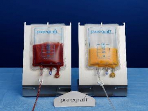 PureGraft 50 PURE-INT System VE 5