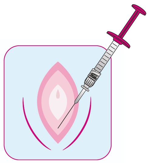 Regenyal Armonia Hyaluronsäure: Innovative Lösung für Intimverjüngung und Genitalkorrektur 2x1ml